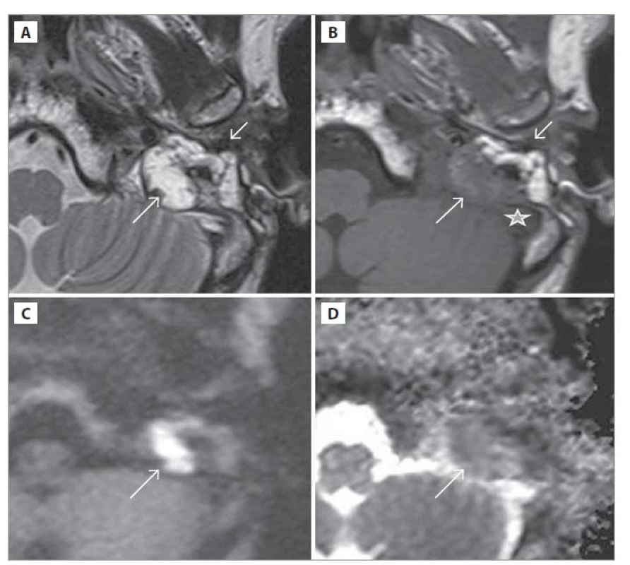 MR spánkových kostí.<br>
a) T2-vážený obraz, b) T1-vážený obraz, c) DWI (HASTE), d) ADC mapa; pred 5. revíznou
operáciou. Cholesteatóm naliehajúci na sinus sigmoideus (dlhá šípka), trepanačná
dutina obliterovaná tukovým tkanivom (krátka šípka), sinus sigmoideus
(hviezdička).<br>
Fig. 2. MRI of the temporal bones.<br>
a) T2-weighted image, b) T1-weighted image, c) DWI (HASTE), d) ADC map; before
the 5th revision operation. Cholesteatoma of the sigmoid sinus (long arrow), adipose
cavity obliterated by adipose tissue (short arrow), sigmoid sinus (asterisk).