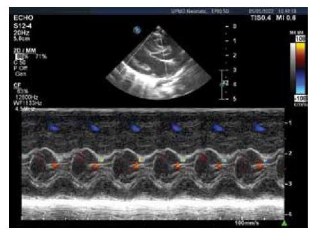Echokardiografie, barevný M-mode levé komory,
střední hypertrofie komorového septa s akcelerací toku
mezi předním cípem mitrální chlopně a komorovým septem
(modrožlutý turbulentní signál)