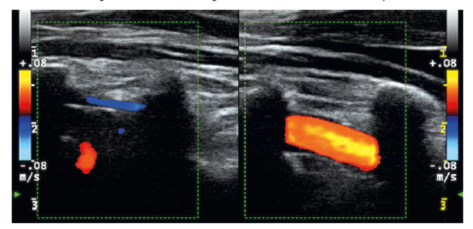 Vľavo je oklúzia AV dx (modrý aj červený signál
z paravertebrálnych vén, v lúmene ohraničenom tenkou stenou
bez AS plátov nie je signál z prietoku), vpravo je normálny
prietok v AV sin. (červený signál v lúmene artérie medzi tieňmi
z priečnych výbežkov).