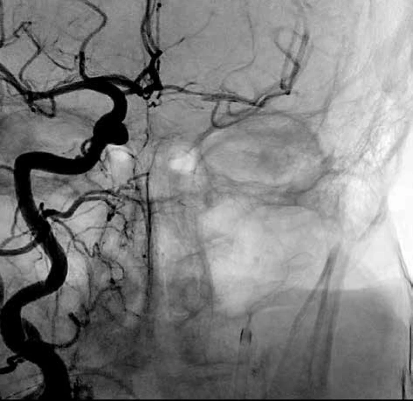 Rekanalizace arteria cerebri media vlevo<br>
Fig. 2: Left middle cerebral artery recanalisation