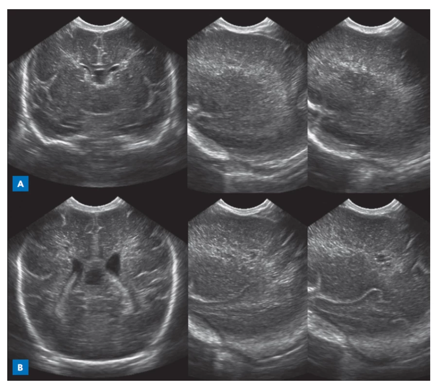 Postižení bílé
hmoty mozkové detekované
ultrazvukem
(koronární a sagitální
projekce přes anteriorní
fontanelu). Hyperechogenity
v periventrikulární
bílé hmotě
(1. den života) (A)
s postupnou progresí
do cystické periventrikulární
leukomalacie
(17. den života) (B).
