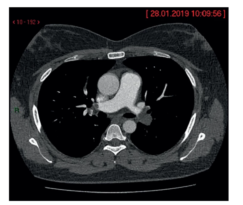 Nádorový embolus v pravom a ľavom ramene
pľúcnice<br>
Fig. 2: Tumor embolus in the right and left branches of the
pulmonary artery