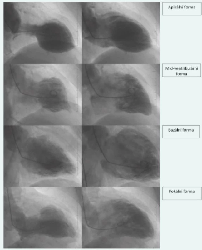 Na přístrojovém záznamu je zobrazena ventrikulografie: v levé části obrázků levé komory v systolické fázi
s patrnou poruchou regionální funkce (celkem 4 typy poruch regionální funkce) a v pravé části levé komory
v diastolické fázi. Přístrojový záznam je uveřejněn s laskavým svolením III. interní-kardiologické kliniky
3. LF UK a FN KV, Praha