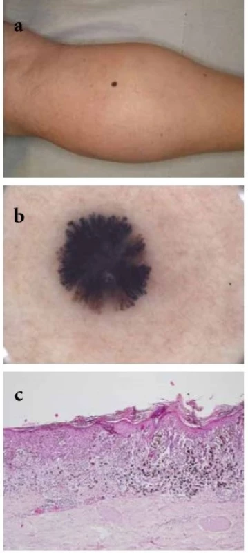  a-c. Melanoma in situ s dermatoskopickým obrazem připomínajícím
Reedův névus u dospělého pacienta