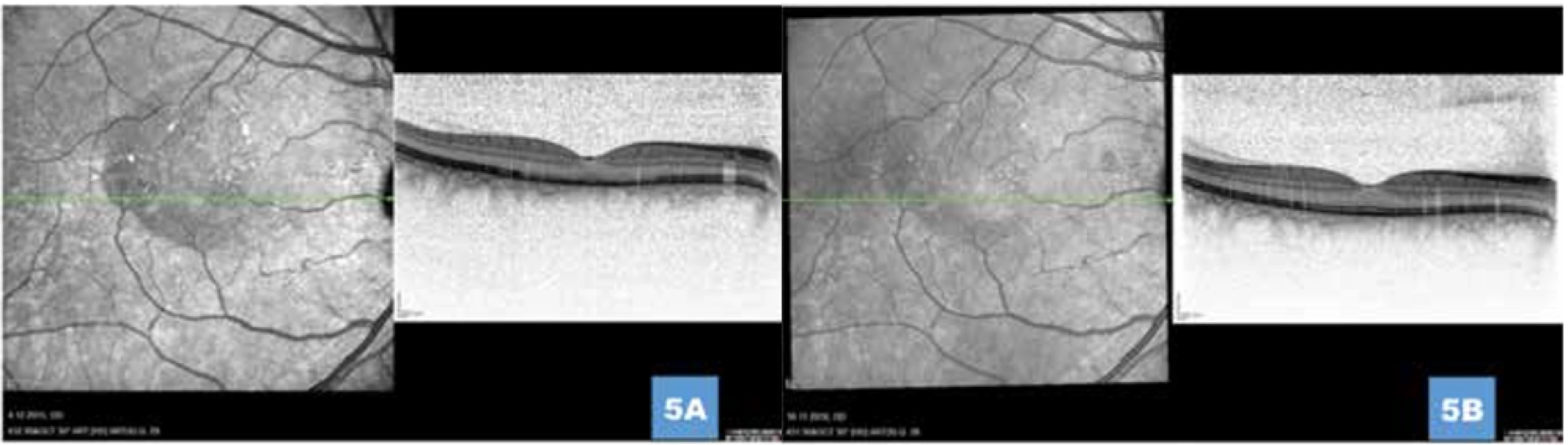 (A) Ústup aktivity onemocnění s postupnou normalizací retinálních vrstev 1 měsíc, respektive (B) 1 rok po provedení fotodynamické léčby