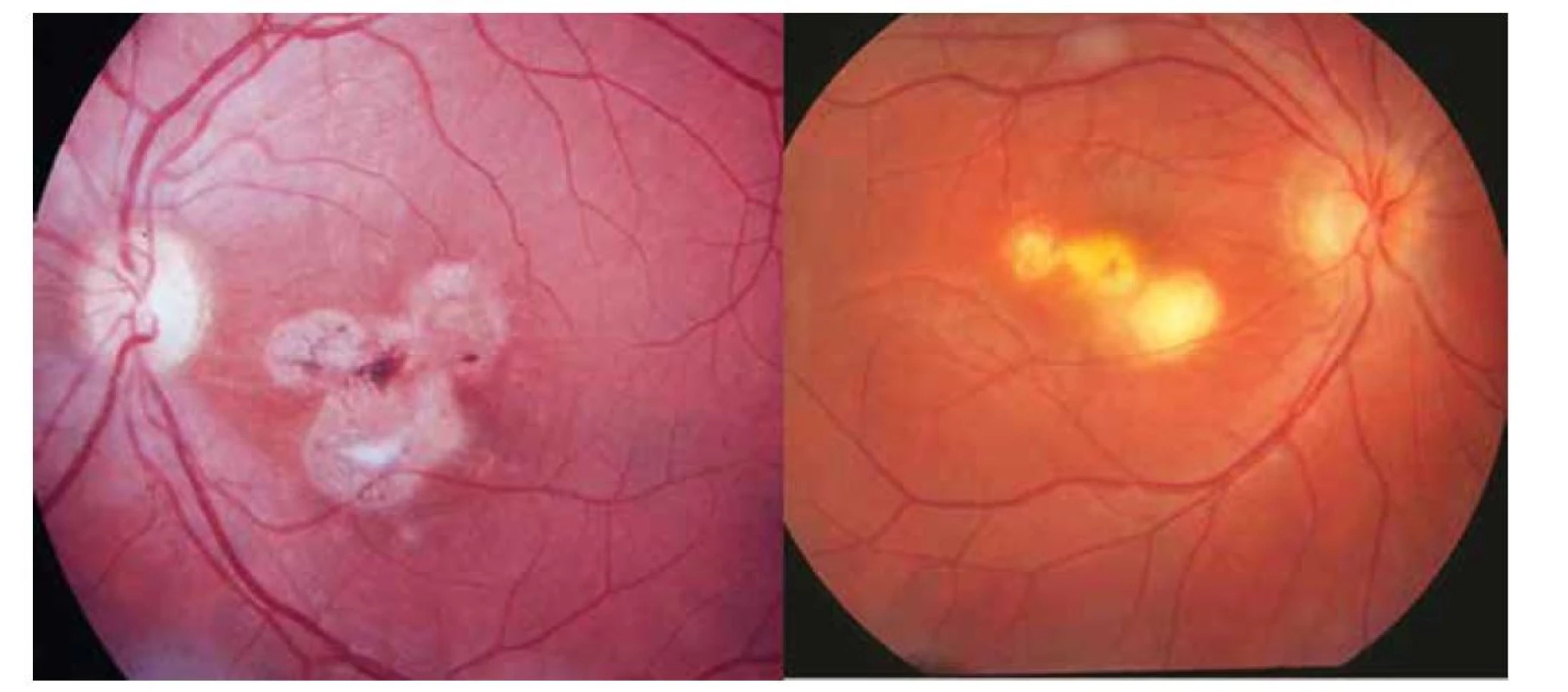 Stav po rekurentní formě okulární toxoplazmózy v podobě tří satelitních ložisek: u chorioretinitidy – vpravo a retinochoroiditidy
– vlevo