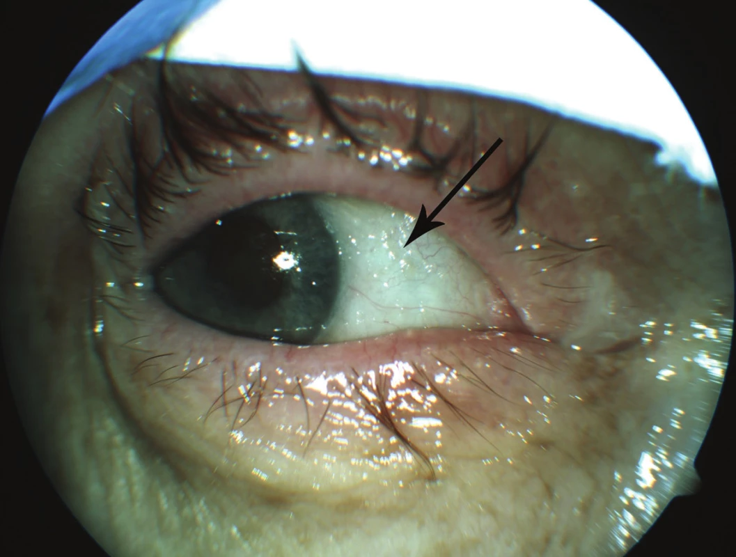 Typical finding of xerosis upon vitamin A deficiency, arrow indicates Bitot's spot