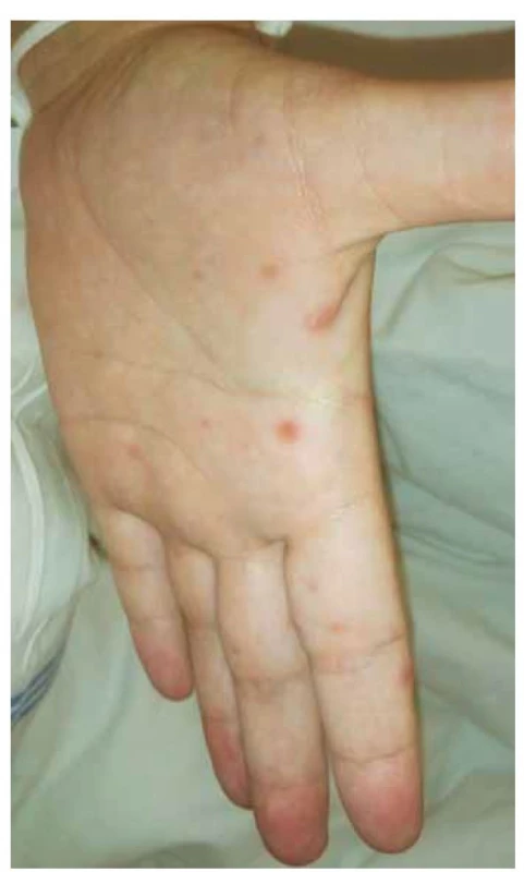 Ukázka exantému na dlani pacientky.<br>
Fig. 1. Exanthema on the palm of the patient's hand.