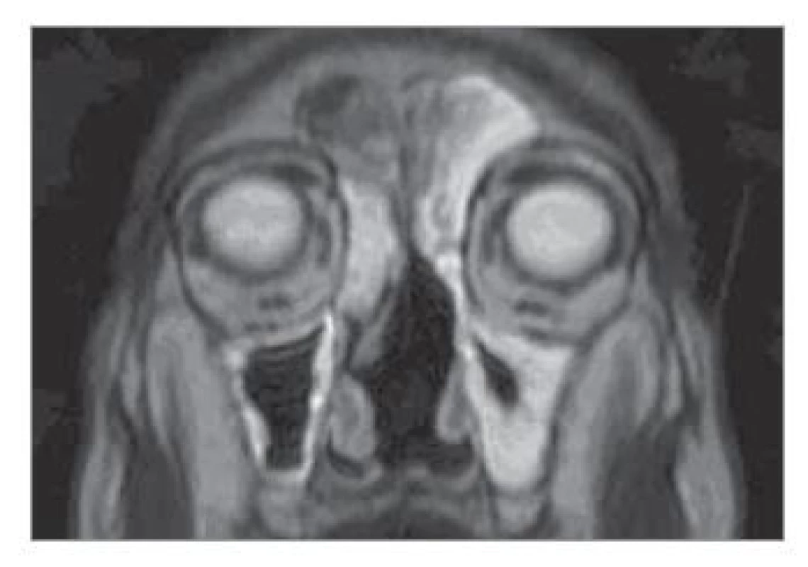 Kontrolní MR hlavy a VND
(koronární projekce, T2 vážený obraz)
za 24 měsíců po léčbě, bez známek
recidivy nádoru.<br>
Fig. 3. Control MR head and VND (coronary
projection, T2 weighted image)
24 months after treatment, no signs of
tumour recurrence.