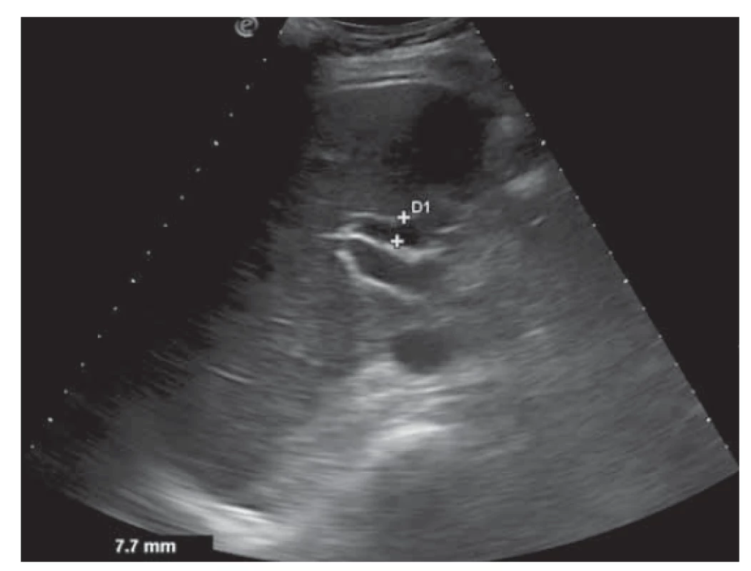 Normálny postcholecystektomický USG nález
ductus choledochus (pri liečbe).<br>
Fig. 3. Normal postcholecystectomy USG finding of common
bile duct (during treatment).