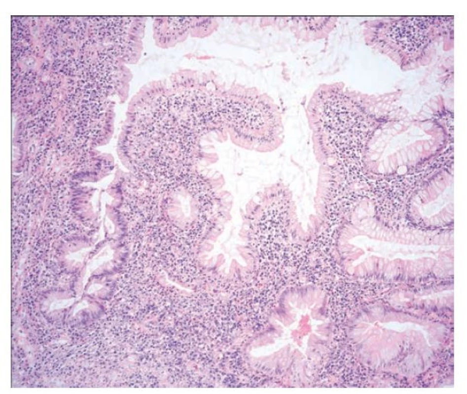 Pilovitá epiteliální změna, pilovitá dysplázie, blíže nespecifikovaná.
Vpravo je na snímku v terénu ulcerózní kolitidy pilovitá epiteliální
změna. Žlázky jsou větvené až pilovité, protáhlé a epitel jeví ztrátu hlenu
a eosinofilii. Vlevo je pak zastižen přímý přechod do cytologických atypí,
které již odpovídají low-grade dysplastickým změnám (hematoxylin a eosin,
100x).