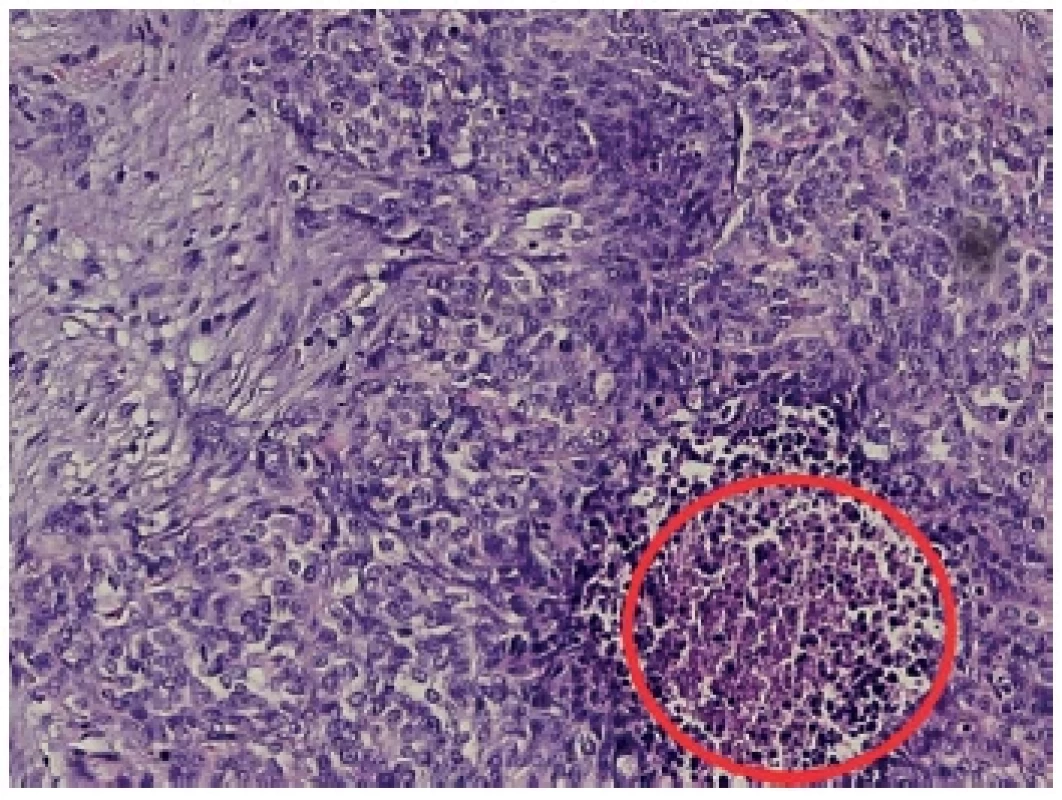 Histologický preparát
Barvení hematoxylin/eozin, zachyceny nádorové struktury
s desmoplastickým stromatem, malé hyperchromní buňky
s modrými jádry s pouze ojediněle patrnými nukleoly. V červeném
kroužku označen okrsek nekrózy. <br> 
Fig. 4. Histological sample
Hematoxylin/eosin, captured tumor structures with desmoplastic
stroma, small hyperchromic cells with blue nuclei with
only rarely visible nucleoli. Necrosis in the red circle.