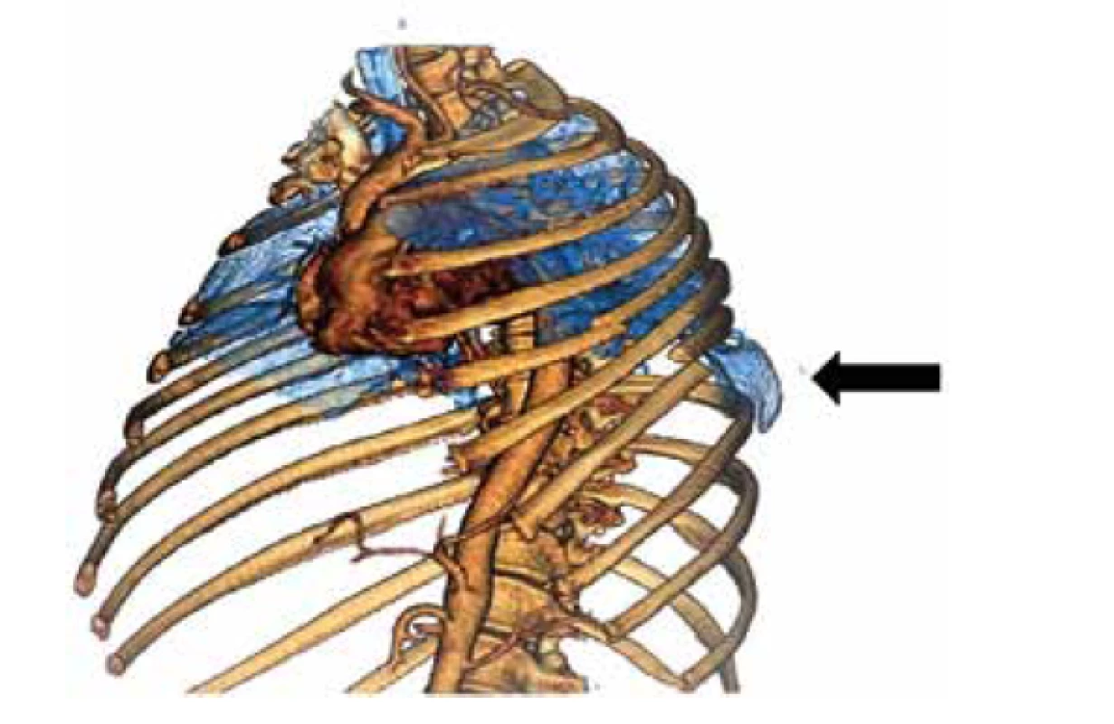 CT 3D rekonstrukce hrudníku, šipka označuje místo
herniace<br>
Fig. 1: 3D CT reconstruction of the chest, the arrow indicates
the point of herniation