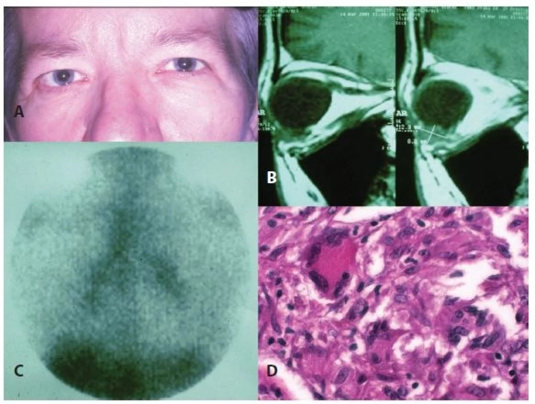 Clinical picture of orbital affliction in right eye (a), finding of orbital tumour on MR (b), image of galli scan (c) and histological verification of orbital biopsy (d) in patient with orbital inflammatory syndrome and intrathoracic manifestation of sarcoidosis
