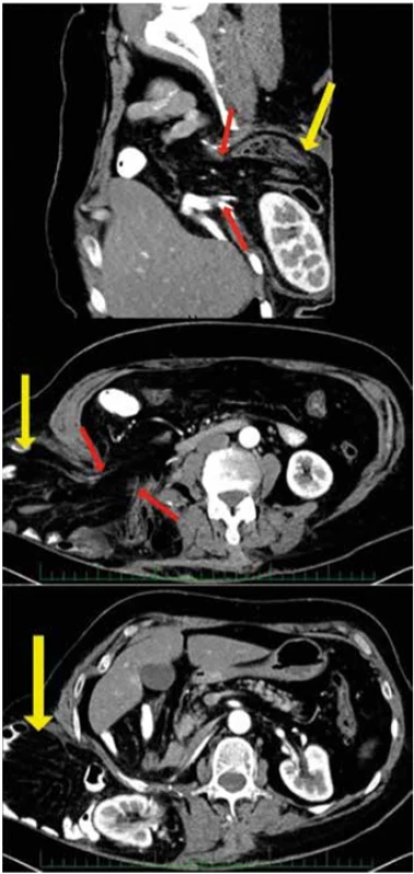 CT vyšetření (kýlní vak označen žlutou šipkou, kýlní branka červenými šipkami) <br>
Fig. 2CT scan (hernia sac marked by the yellow arrow; abdominal defect marked by the red arrows)
