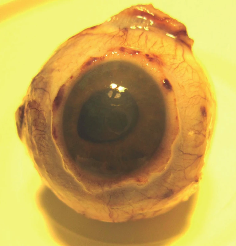 Enucleated eyeball in 2013 