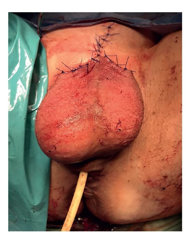Rekonstrukce kůže šourku a vyšití perineální uretrostomie<br>
Fig. 3: Reconstruction of scrotal skin and perineal urethrostomy