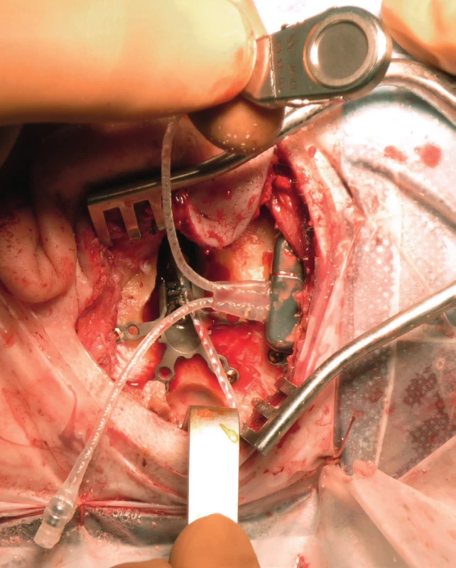 Operace Cariny®, pravé ucho. Implantát je vložen
do lůžka v kosti vpravo, chirurg drží v prstech mikrofon, který
bude uložen do malého lůžka v kosti v dolní části obrázku (pod
retraktorem). Celý systém je již šrouby upevněn do trepanační
dutiny, zbývá spojit konektor vedoucí od implantátu (vlevo
dole) s konektorem od aktuatoru (operatér prof. Tringali, Lyon,
Francie).