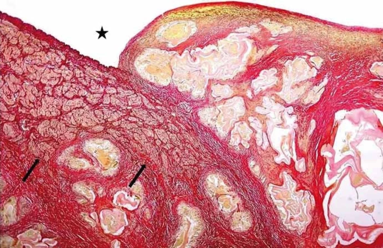 Angioinvaze nevitálních parazitárních struktur echinokoka do cévních struktur. Hvězdička ukazuje lumen cévy, šipky muskuloelastické složky cévní stěny destruované parazitem (barvení SREL, původní zvětšení 100×). (Zdroj: MUDr. Hana Skopcová).<br>
Fig. 1. Angioinvasion of non-vital parasitic structures of echinococcus into vessels. The star shows the vessel lumen; arrows show musculoelastic tissue of the vascular wall infi ltrated by parasitic structures (SREL staining, original magnifi cation ×100). (Author: MUDr. Hana Skopcová).