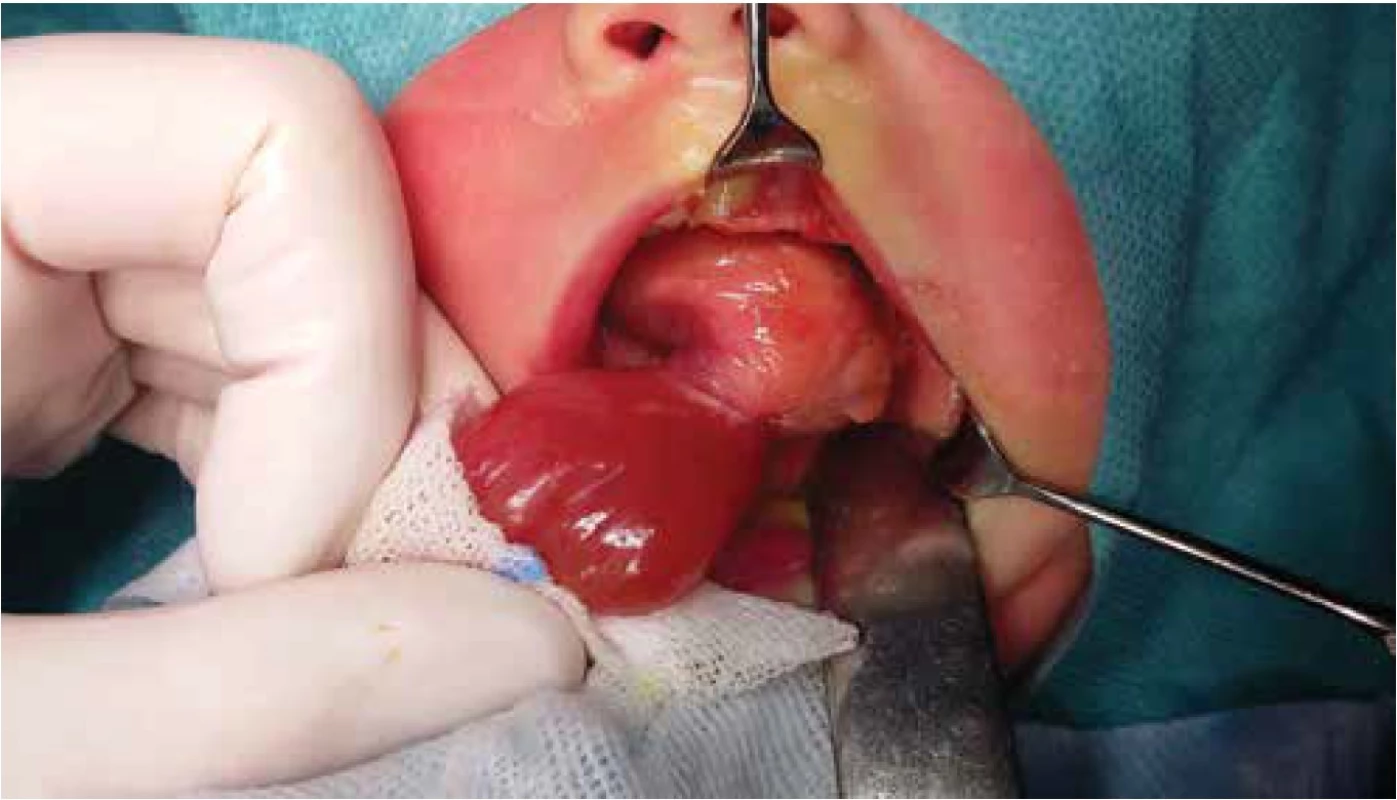 Exstirpace tumoru v lokální anestezii.<br>
Fig. 2. Extirpation of the tumour under local anesthesia.