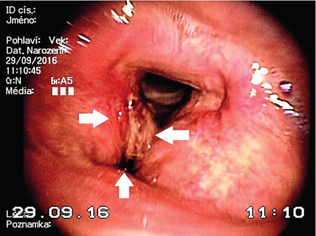 Indirect laryngoscopy was recommended for the
patient. The arrows signed the tumor on the right side. The residual
mobility of arytenoids was detected. Indirect laryngoscopy
showed a pedunculated large epiglottis (arrow down) and right
side (between right and left arrows) lesion no causing airway
obstruction.