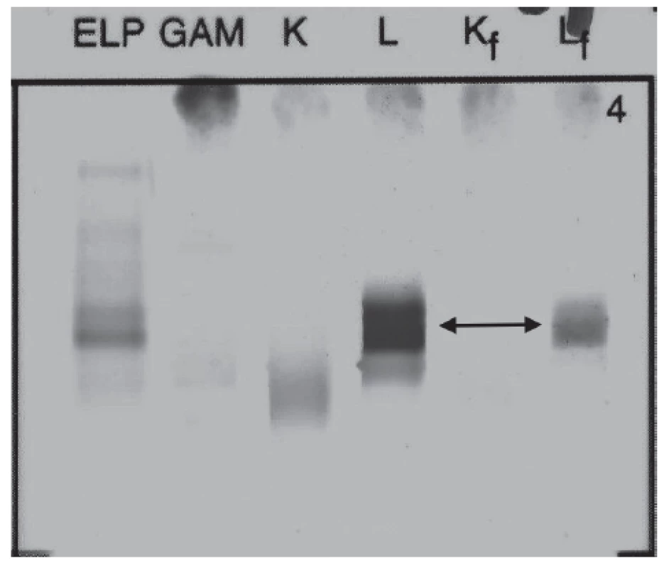 Immunofixation electrophoresis of patient´s urine sample
presenting Lambda Bence-Jones protein.