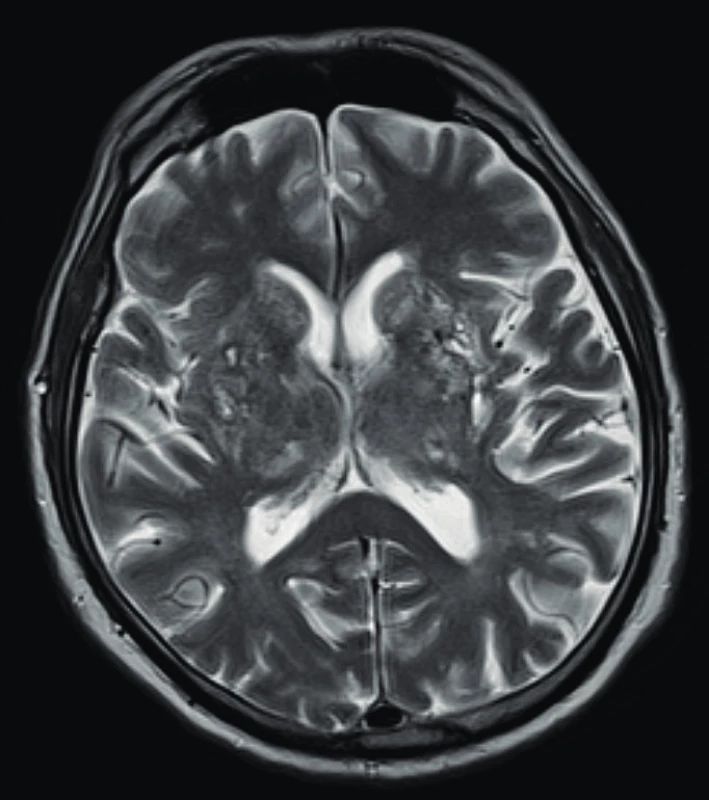 Magnetická rezonance mozku u pacienta s granulomatózou
s polangiitidou a postižením CNS s obrazem vaskulitidy se
změnami supratentoriálně a mnohočetnými akutními i subakutními
ischemiemi (Radiologická klinika FN, Olomouc)