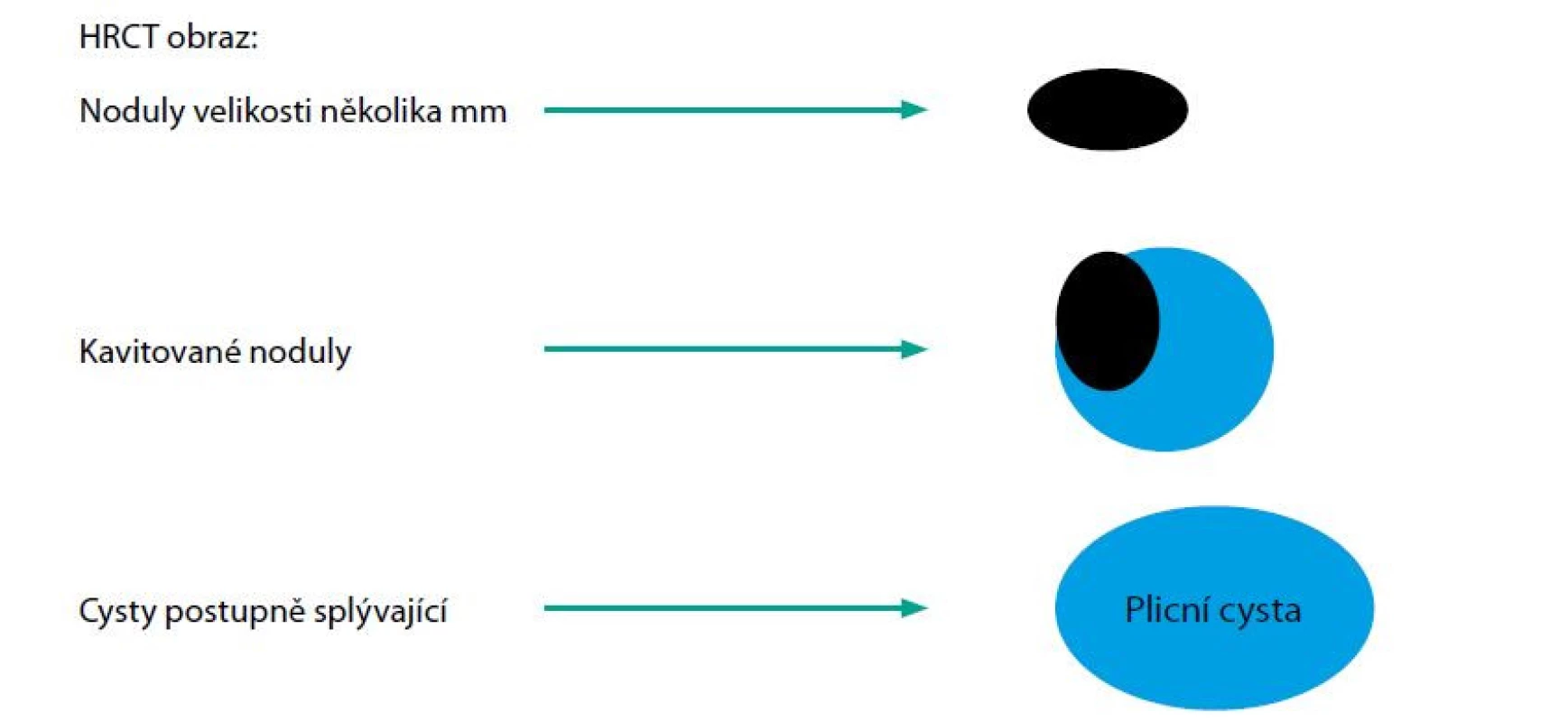 Schematické znázornění vývoje plicní formy LCH. Počátečný morfou je nodulus, v němž postupně vzniká kavita, které se promění v cystu. Více cyst
pak může splývat a vytvořit značně velké cysty, jak ukazuje další obraz. Tyto velké cysty pak mohou způsobit spontánní pneumotorax