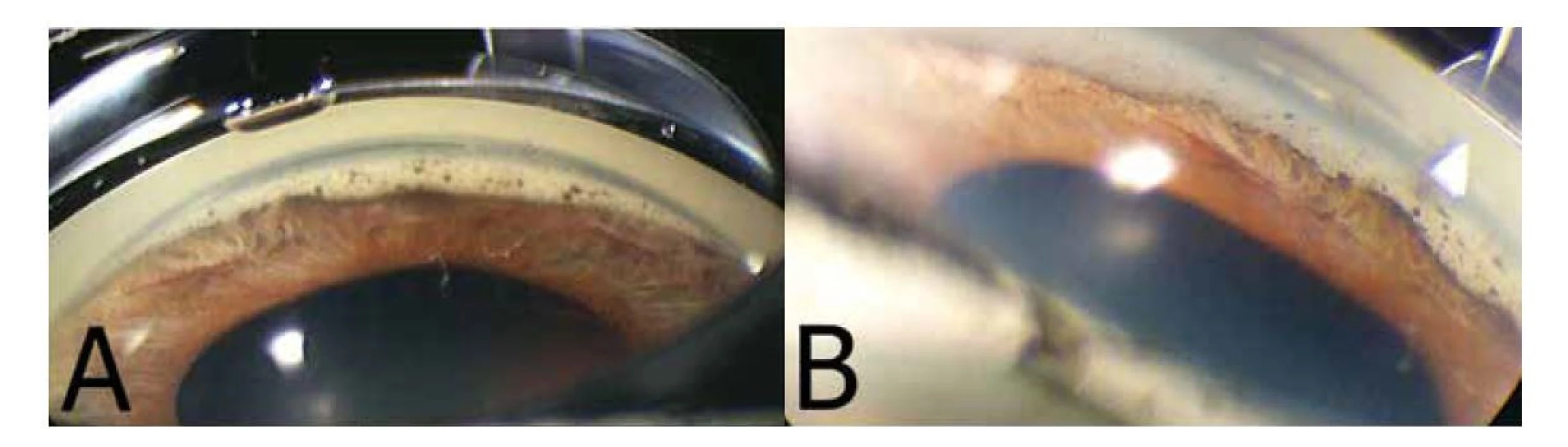 Gonioskopická fotografie pravého oka znázorňující výraznou disperzi pigmentu a přední synechie v komorovém úhlu