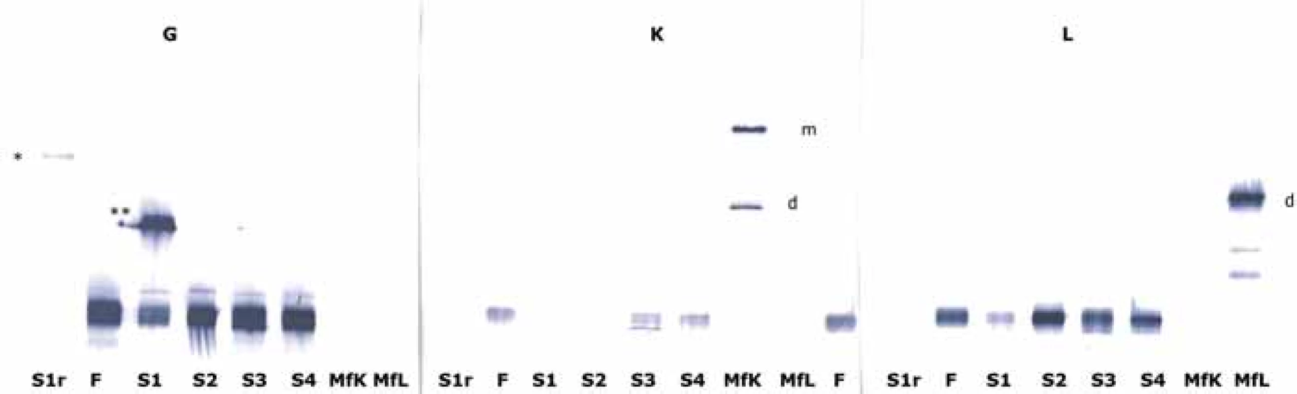 Výsledky SDS elektroforézy následované blotováním na nitrocelulózovou membránu a imunodetekcí těžkých řetězců imunoglobulinu
gama (G), lehkých řetězců kappa (K) a lambda (L). Anoda je nahoře. Kromě pruhu v S1r (vzorek redukovaný dithiotreitolem)
byly použity neredukční podmínky. Abnormální fragment řetězce gama migruje mírně pomaleji než fLC monomer v redukovaném
vzorku (*) a je mírně pomalejší než FLC dimer v neredukovaném vzorku (**), současně zřetelně rychleji než monomery IgG (dole), které
nereagovaly ani s jednou protilátkou proti lehkému řetězci kappa nebo lambda. Ve srovnání s pozicemi monomerů a dimerů fLC (MfK
a MfL) a transferinu (v jiném experimentu, neuvedeno) je odhadovaná molekulová hmotnost fragmentu mezi 50 a 70 kDa.
FLC – volný lehký řetězec, m – monomer, d – dimer, MfK a MfL – monoklonální volné řetězce kappa a lambda, S1 – náš pacient, S2 – vzorky
séra s monoklonálním IgG lambda, S3 – vzorek séra s monoklonálním IgG kappa.
Porovnáním chování redukovaného vs. neredukovaného vzorku se domníváme, že paraprotein se bude pravděpodobně sestávat ze
dvou fragmentů řetězce gama (H2, zkrácený), jeho Fc části (proti které je protilátka namířena) spíše než z jednoduchého řetězce gama
(H1).