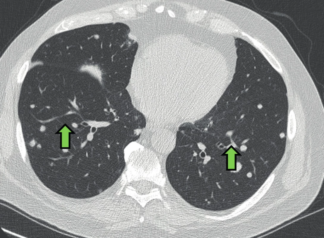 HRCT hrudníku pacienta s IgG4 asociovaným onemocněním a
plicním postižením. Difuzní nodularity oboustranně (zelená šipka)