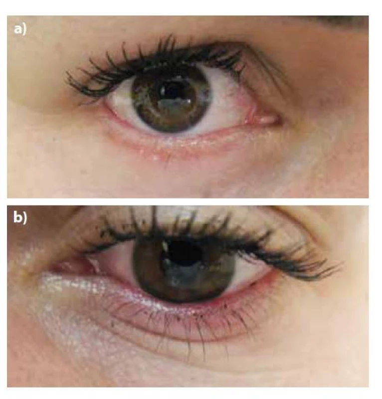 Regrese postižení pravého (3a) a levého (3b) očního
víčka při léčbě hydroxychlorochinem