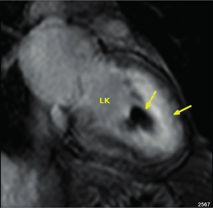 Obraz endomyokardiální fibrózy při vyšetření magnetickou rezonancí v horizontální dlouhé ose: plná šipka označuje silný hypersignální
lem pozdního sycení kontrastní látkou odpovídající na endokard nasedající
fibrotické obliteraci hrotu levé komory, šrafovaná šipka pak označuje hyposignální trombotické jádro v jejím nitru (LK – levá komora)
