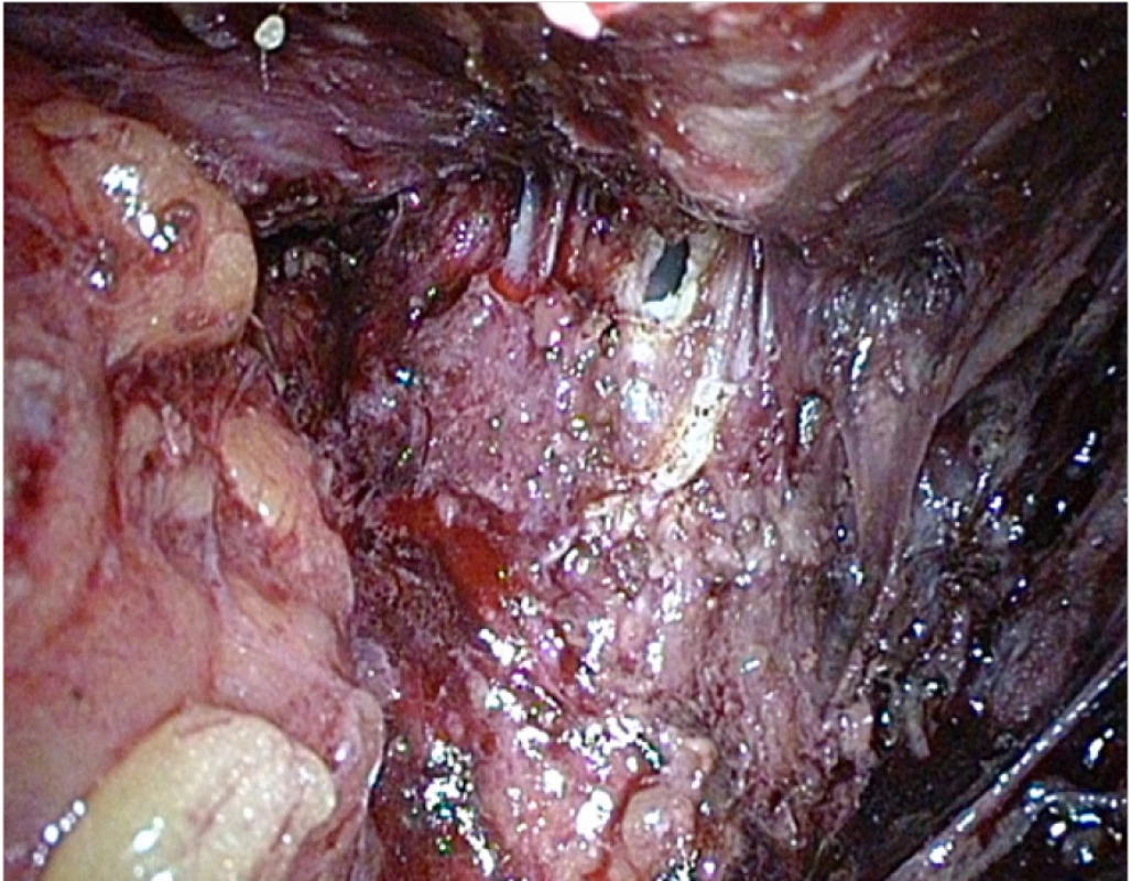 Peroperační léze rekta po apikální disekci
prostaty<br>
Fig. 2. Peroperative rectal lesion after apical dissection
of the prostate