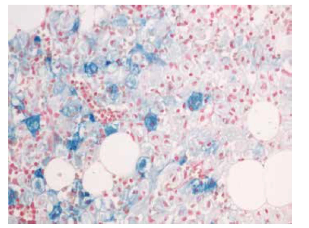 Histochemické barvení na železo (Fe) s pozitivitou gaucherových
buněk (zvětšení 200x).