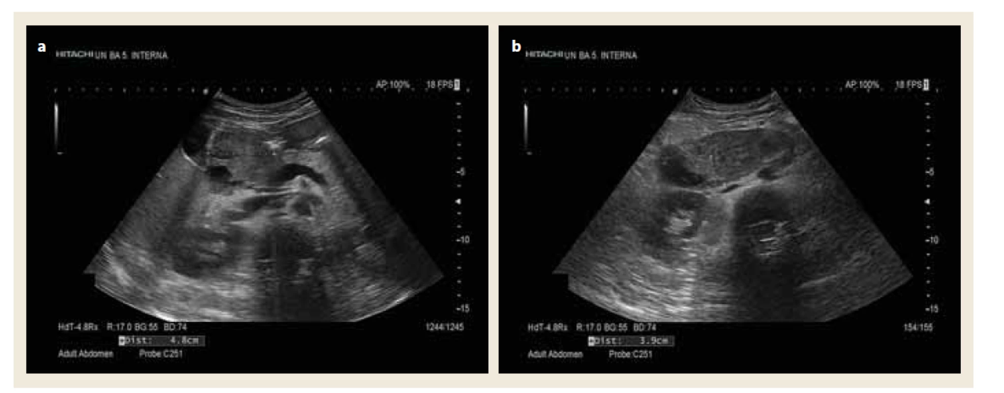 USG obraz spontánneho intramurálneho hematómu duodena.<br>
a) Priečny prierez.<br>
b) Šikmý prierez.<br>
Fig. 1. Ultrasound scan of a spontaneous intramural duodenal hematoma.<br>
a) Transverse section.<br>
b) Oblique section.