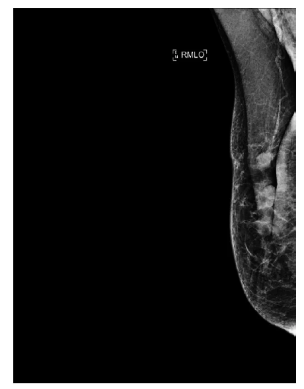 Mamograf, pooperační deformace prsu, vtažení
mamily, nejasná změna v horní části jizvy, zachycená
část axily bez jednoznačné lymfadenopatie.<br>
Fig. 8: Mammogram, postoperative deformity of the breast,
retraction of the nipple, unclear change in the upper
part of the scar, shown part of the axilla without clear
lymphadenopathy.