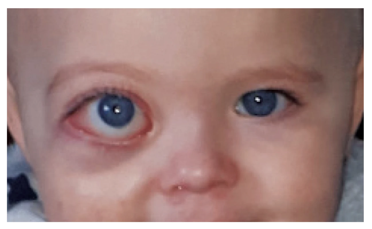Proptosis of right eyeball with facial asymmetry.
Photograph obtained at the age of 14 months