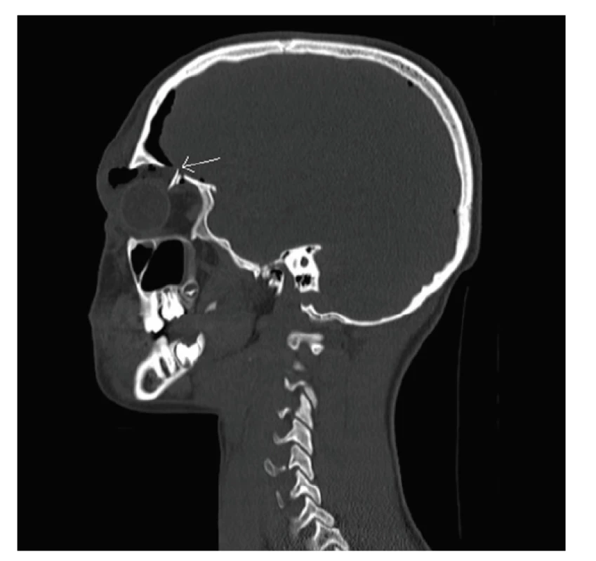 Blow-in fraktura stropu očnice s dislokovaným
úlomkem zasahujícím do horního přímého okohybného svalu
(šipka), CT vyšetření, sagitální řez
