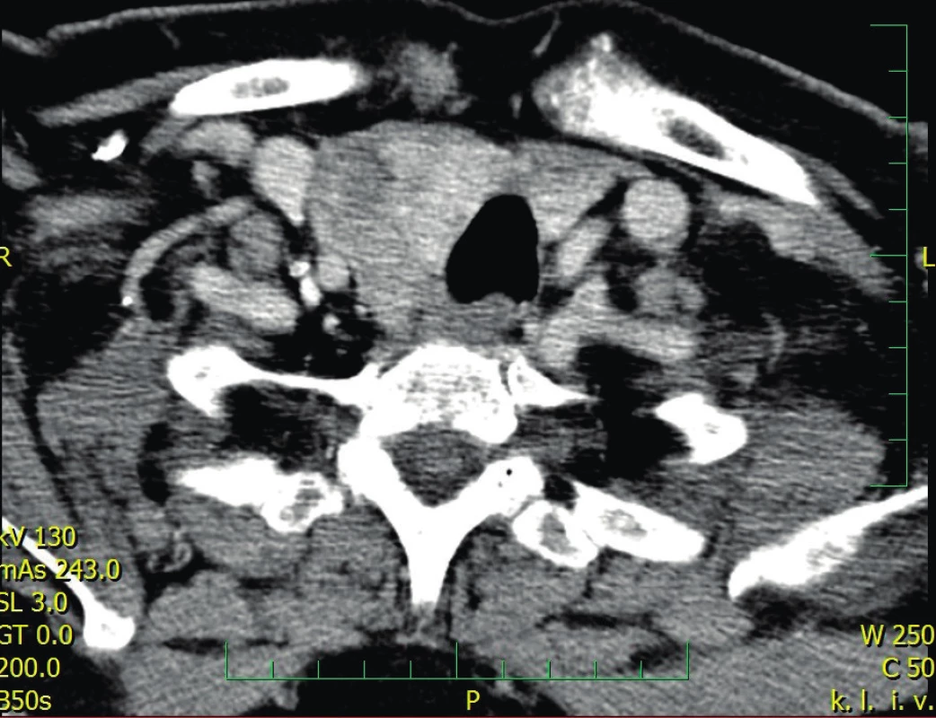 CT vyšetření: prokrvácený tumor vpravo prevertebrálně a mezi tracheou a štítnou žlázou