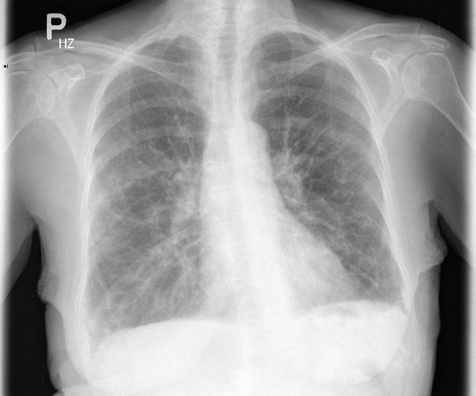Vstupní skiagram hrudníku – retikulace, místy až splývavé
infiltrace predominantně ve středních plicních polích
