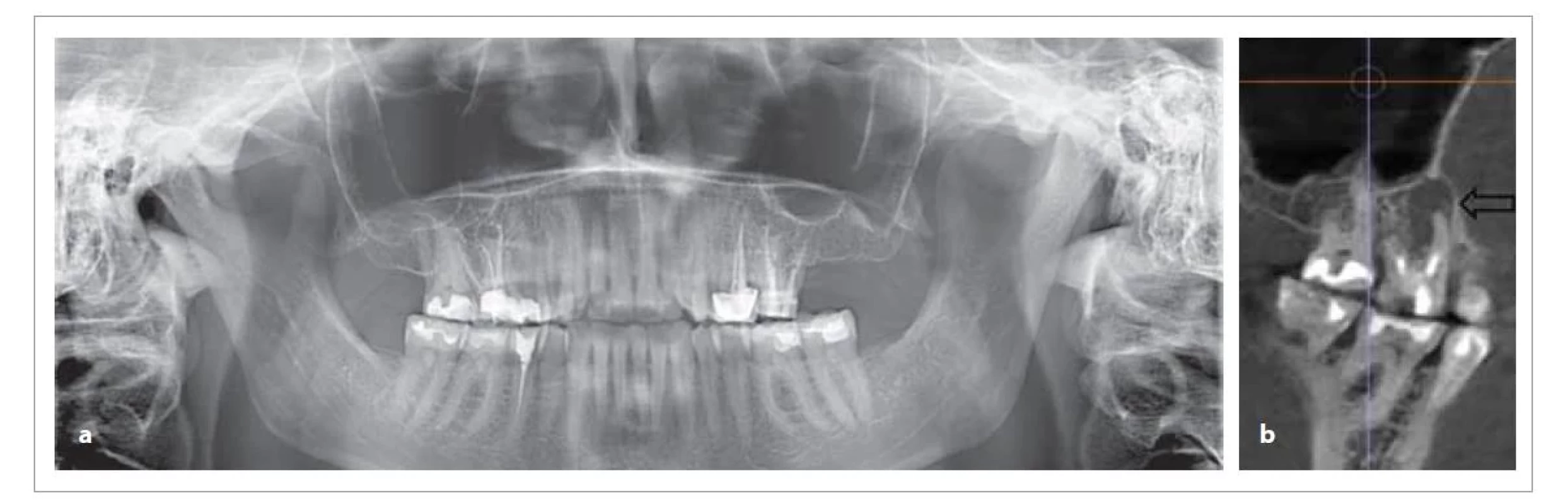 Srovnání OPG a CBCT u téhož pacienta, možnost diagnostiky periapikální patologie zubu 16 z OPG snímku je
velmi omezená a snadno přehlédnutelná, zatímco z CBCT vyšetření je nález zcela jednoznačný (a – OPG, b – CBCT).<br>
Fig. 1. Comparison of OPG and CBCT in the same patient, the possibility of diagnosing periapical lesion of tooth 16 from the
OPG is very limited and easily overlooked, while from the CBCT examination the finding is quite clear (a – OPG, b – CBCT).
