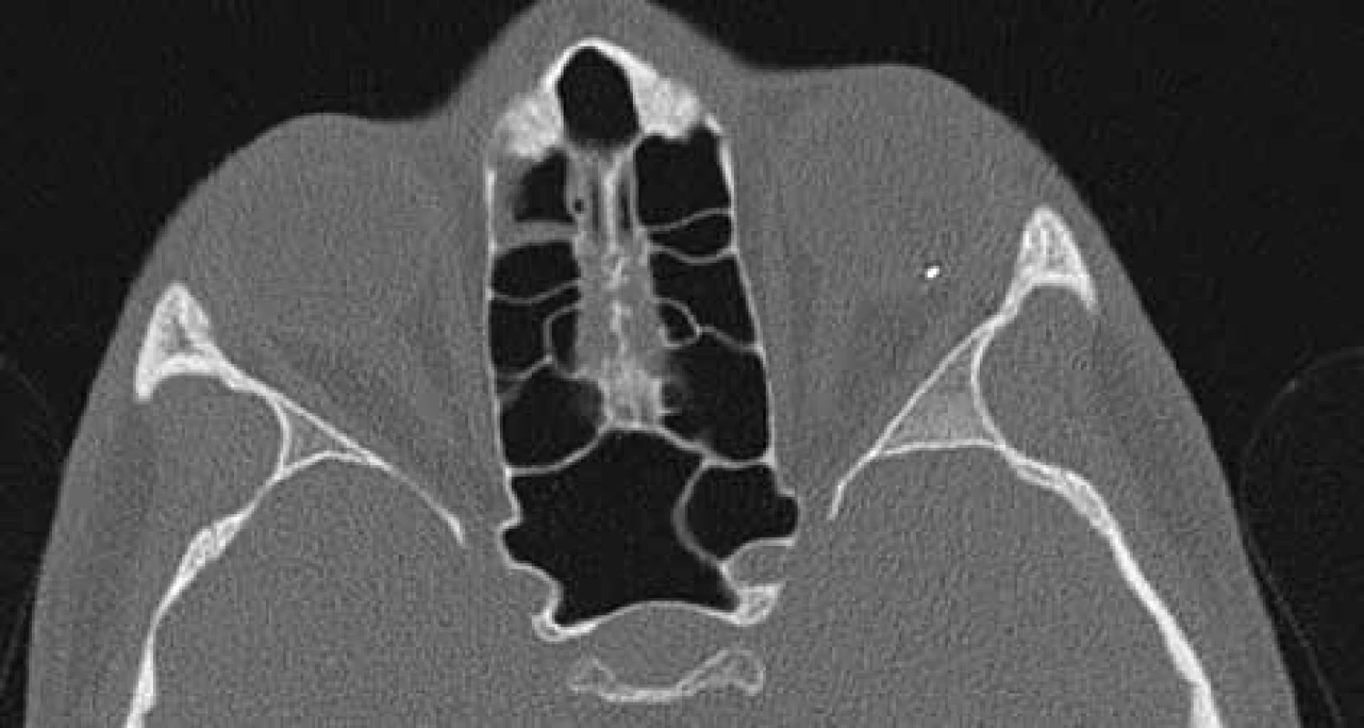 Metalické nitrooční cizí tělísko (NCT) v CT obraze