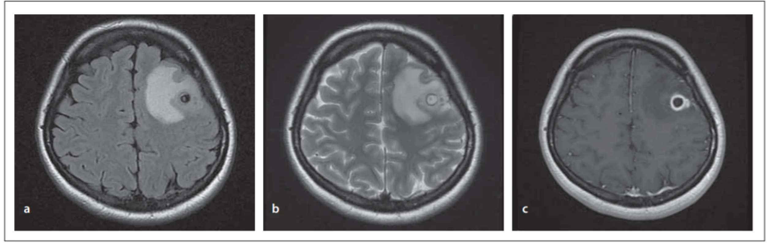 MRI of the brain, transverzal images. Cystic ring enhancing lesion in the left frontal region, with distinct perifocal oedema; most likely
a granular nodular stage of neurocysticercosis. (a) T1 weighted image; (b) T2 weighted image; (c) T1 weighted image with gadolinium.<br>
Obr. 2. MR mozku, transverzální řezy. Cystické ložisko frontálně vlevo s enhancujícím prstencem, s výrazným perifokálním edémem. Nejspíše granulárně nodulární stadium neurocystercerkózy. (a) T1 vážený snímek; (b) T2 vážený snímek; (c) T1 vážený snímek s gadoliniem.