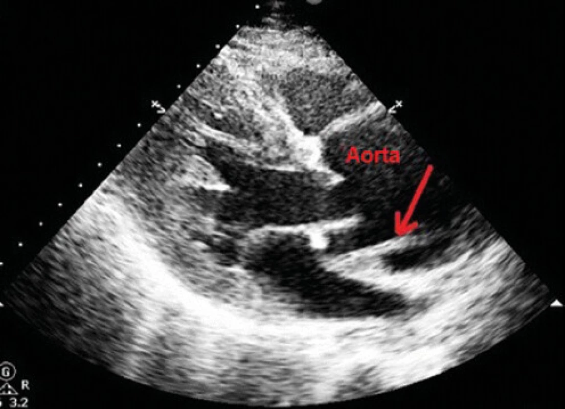 Transtorakálne echokardiografické vyšetrenie srdca odhalilo dilatovaný koreň aorty a intimálny flap