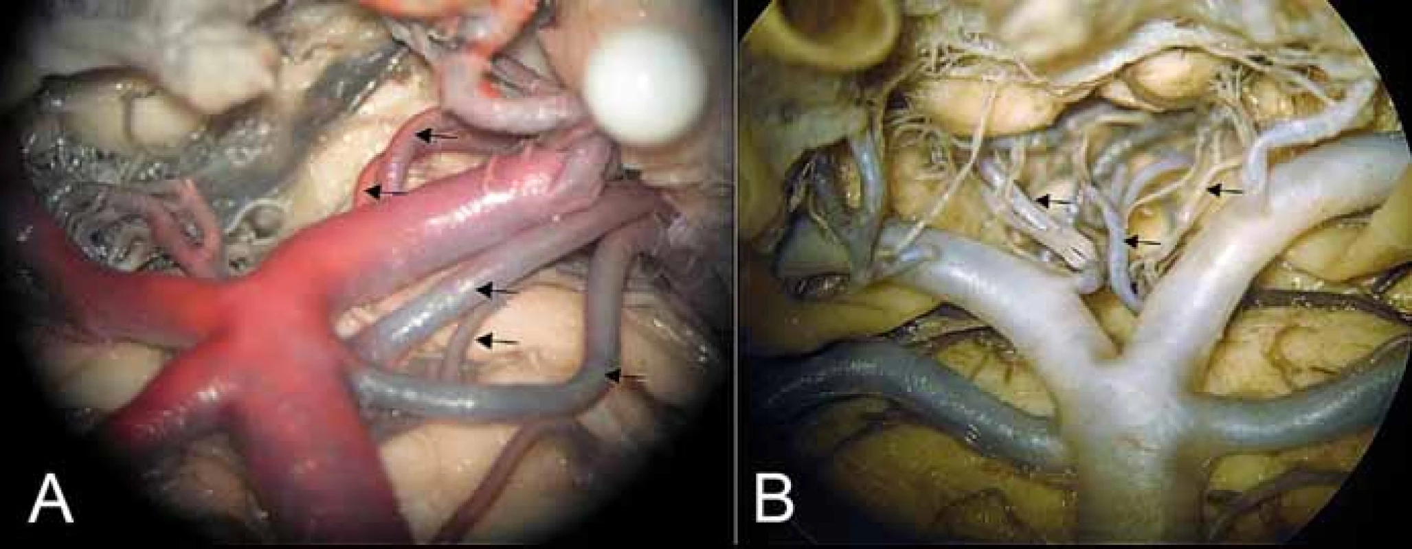 (A) Oblast bifurkace arteria basilaris, odstup arteria choroidea posterior medialis
a arteria collicularis z P1 (kraniální 2 šipky), zdvojení arteria cerebelli superior a mezi nimi
posterolaterální pontinní arterie. (B) Interpedunkulární perforátory (mediálně oboustranně)
a anterolaterální (pedunkulární) větévka (šipka vlevo).<br>
Fig. 4. (A) Area of basilar artery bifurcation with the medial posterior choroidal artery
and collicular artery branching from P1 (2 upper arrows), double superior cerebellar arteries
with the posterolateral pontine artery between them. (B) Interpeduncular perforators
(medially bilaterally) and anterolateral – (peduncular) branch (left arrow).