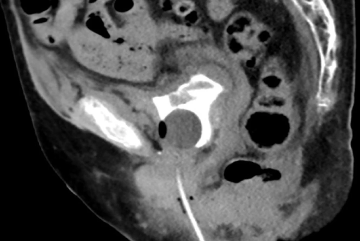 CT cystografie sagitální
řez, močový měchýř při
menší náplni bez úniku kontrastní
látky<br>
Fig. 2. CT cystogram sagittal
view. Partial filling of the urinary
bladder with no contrast
leak demonstrated
