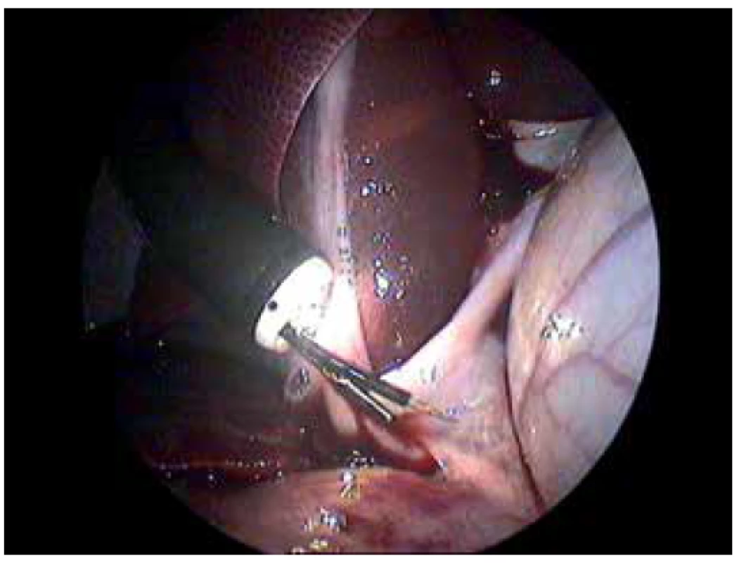 Hybrid NOTES procedure of saline application into the
portal vein<br>
Laparoscopic view of the site of application. In the center of the
view there is the tip of the endoscope with the injector (front
working channel) and grasper (back working channel). Endoscopic
grasper is pulling and fixing tunica adventitia/serosa of
the portal vein. The endoscopic injector is moving closely to the
portal vein.