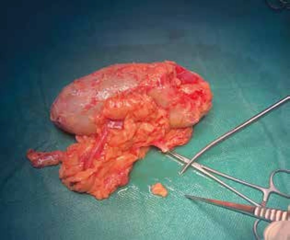 Ledvina od dárce; odběr tukové tkáně<br>
Fig. 1. Living-donor kidney; removal of adipose tissue