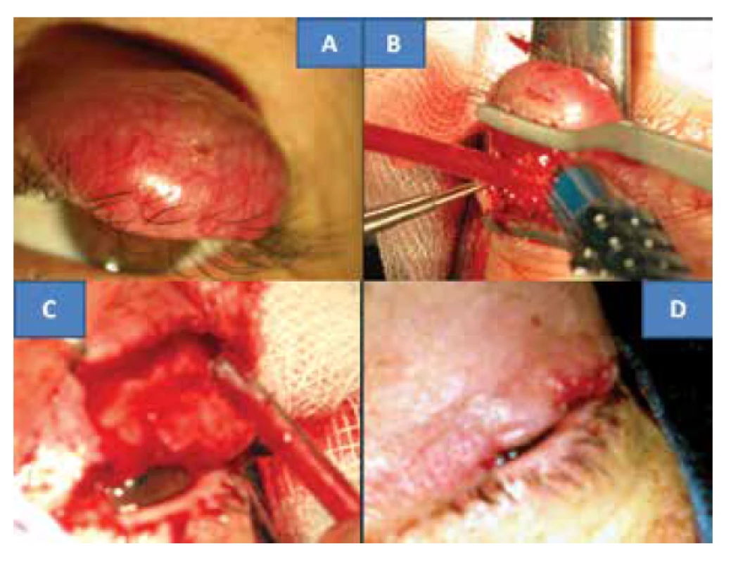 Klinický nález solidního MCC horního víčka u 48-leté
pacientky (A) operační postup: odstranění tu víčka (B,C) s jeho
plastikou (D)